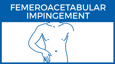 Femoroacetabular impingement