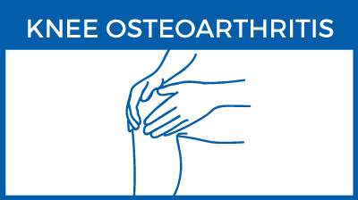 Knee osteoarthritis